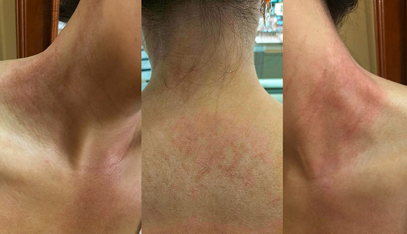Scleroderma caused by Lupus post vaccination